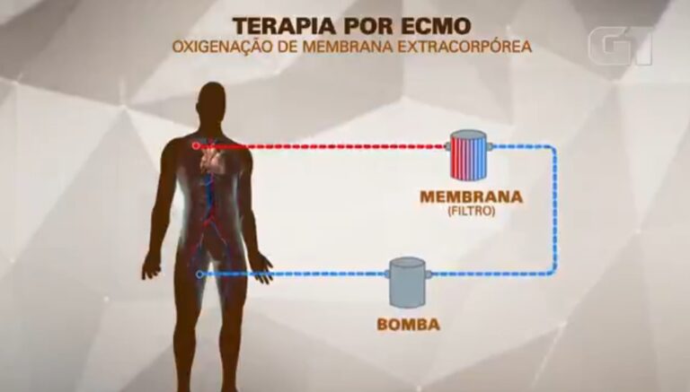 ecmo