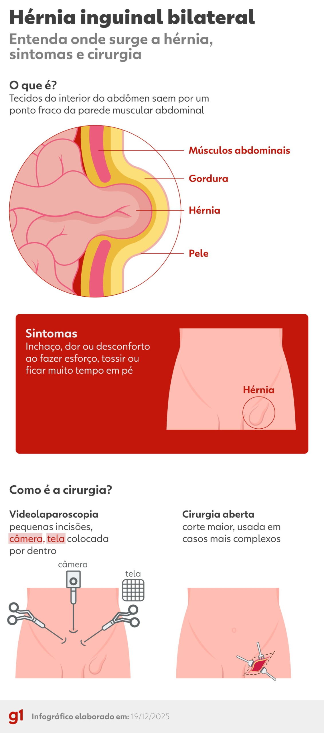 251219-info-hernia-inguinal